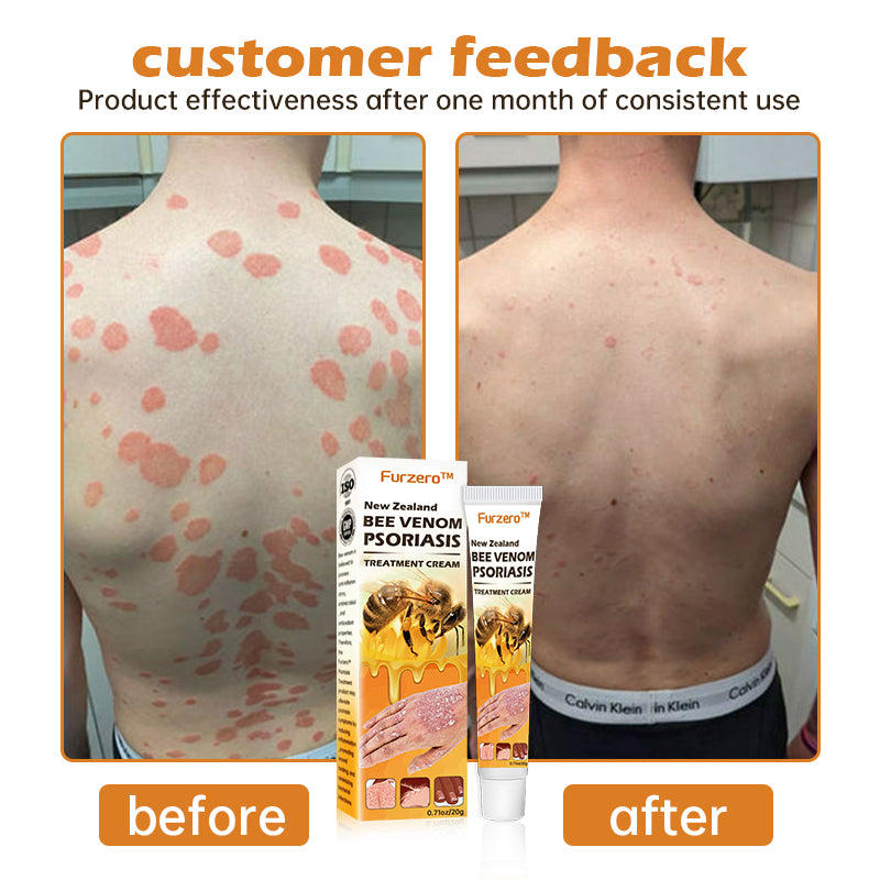Furzero™ New Zealand Bee Venom Psoriasis Treatment Cream