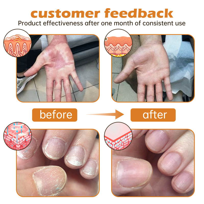 Furzero™ New Zealand Bee Venom Psoriasis Treatment Cream