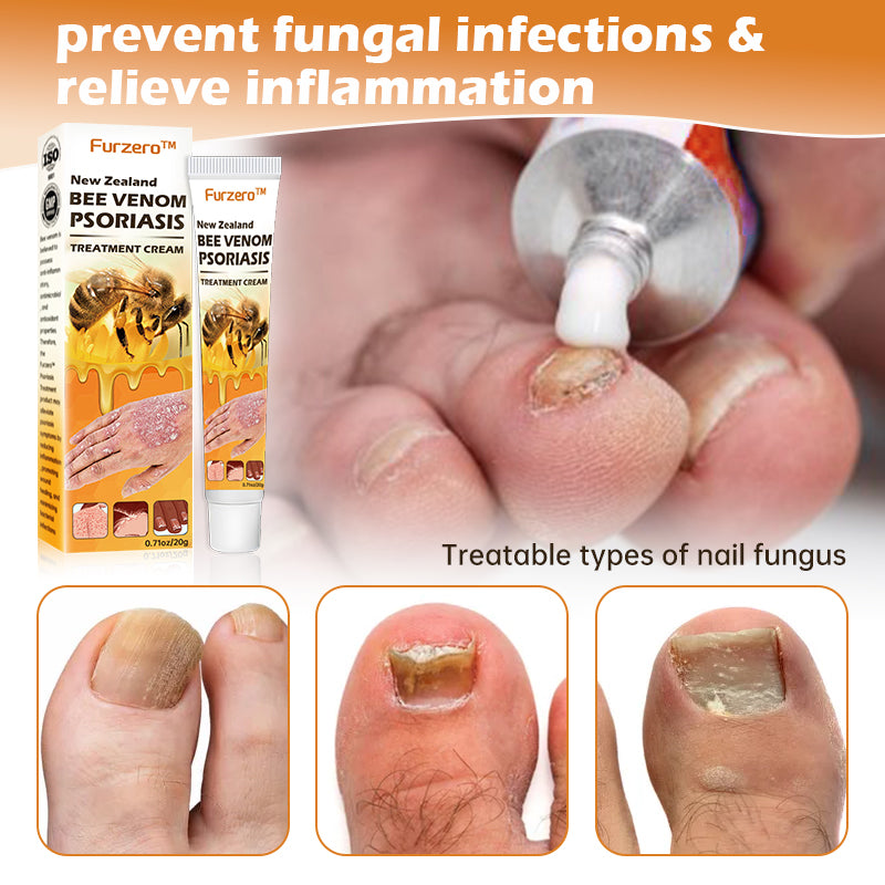 Furzero™ New Zealand Bee Venom Psoriasis Treatment Cream