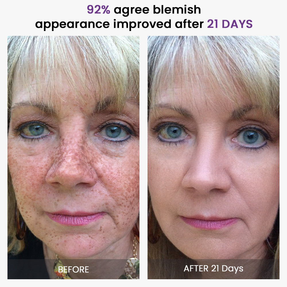 KISSHI™ Rapid Relief Blemish Treatment
