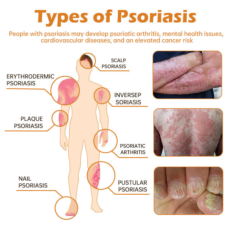 Furzero™ New Zealand Bee Venom Psoriasis Treatment Cream