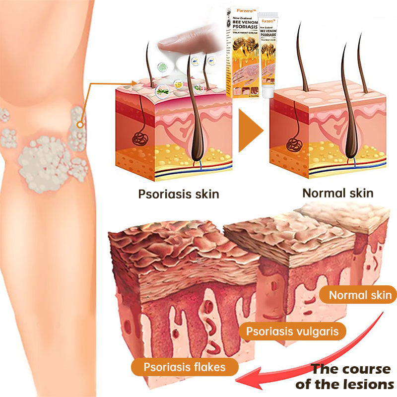 Furzero™ New Zealand Bee Venom Psoriasis Treatment Cream