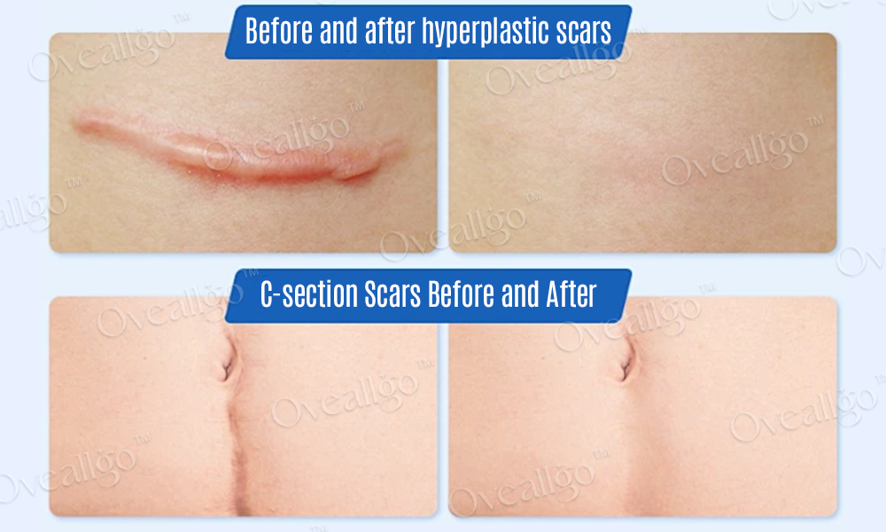 Oveallgo™ Silicone Anti-Scar Cream ✨