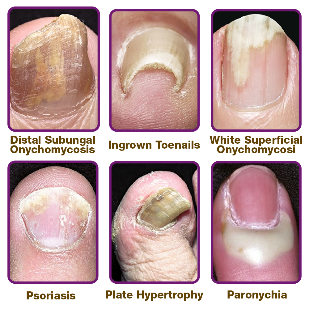 flysmus™ FungiFree Bee Venom Nail Treatment Serum