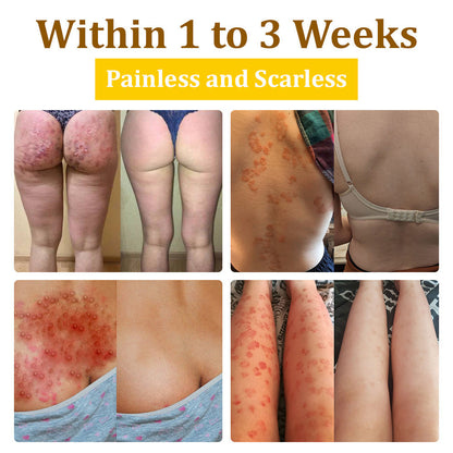 ✅flysmus™ Bee Venom Treatment Cream🐝: Treat Eczema, Psoriasis, Acne, Rosacea, Fungal Infections, Warts