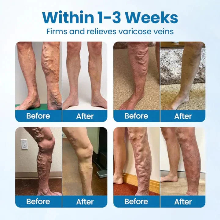 Lyyeto® VeinGuard Herbal Spray-✅ Clinically proven to eliminate varicose veins in just 7 days!