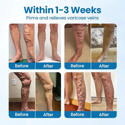 Lyyeto® VeinGuard Herbal Spray-✅ Clinically proven to eliminate varicose veins in just 7 days!