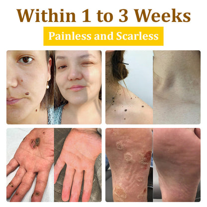 ✅flysmus™ Bee Venom Treatment Cream🐝: Treat Eczema, Psoriasis, Acne, Rosacea, Fungal Infections, Warts