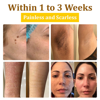 ✅flysmus™ Bee Venom Treatment Cream🐝: Treat Eczema, Psoriasis, Acne, Rosacea, Fungal Infections, Warts