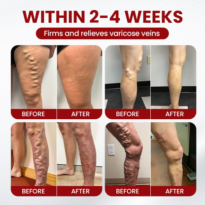 Greenmedii Varicose Veins Cream