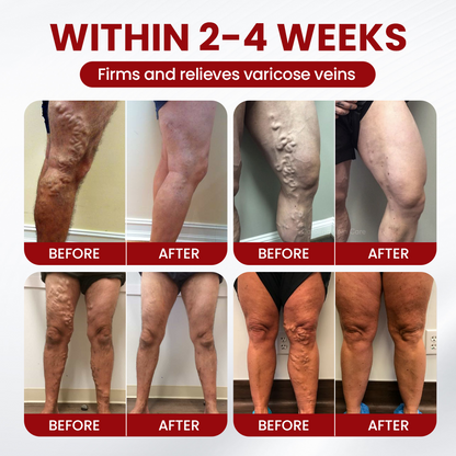 Greenmedii Varicose Veins Cream